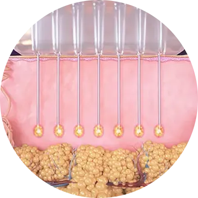 RF Microneedling
